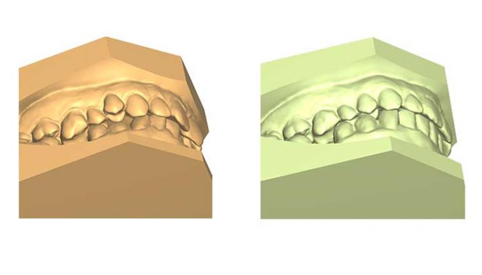 Mixed malocclusions and closed gap after tooth extraction. Six Sessions