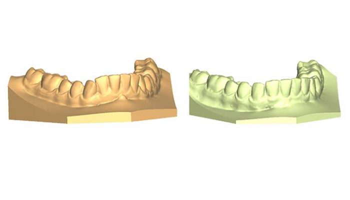 Open bite Seven Sessions