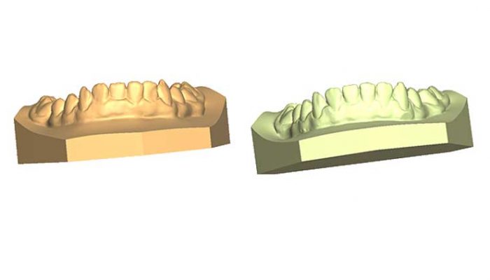 Overbite and Correct alignment Five Sessions