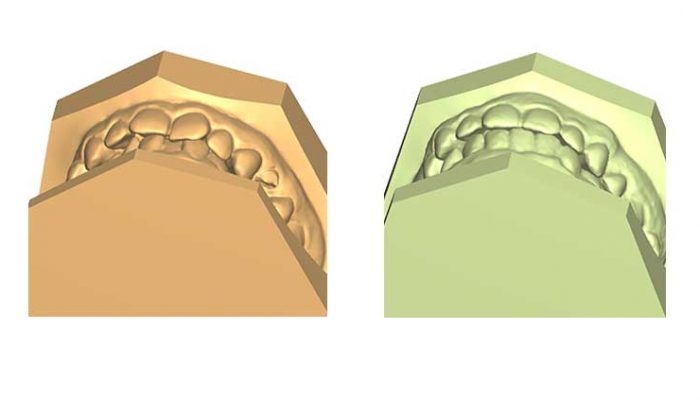 Mixed malocclusions and closed gap after tooth extraction. Six Sessions
