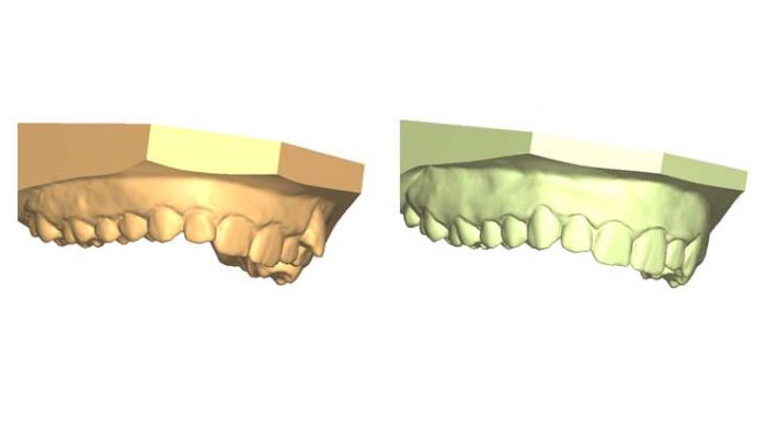 Abnormal Eruption Six Sessions