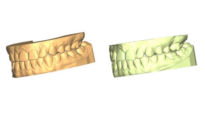Little corrections after other braces Two Sessions