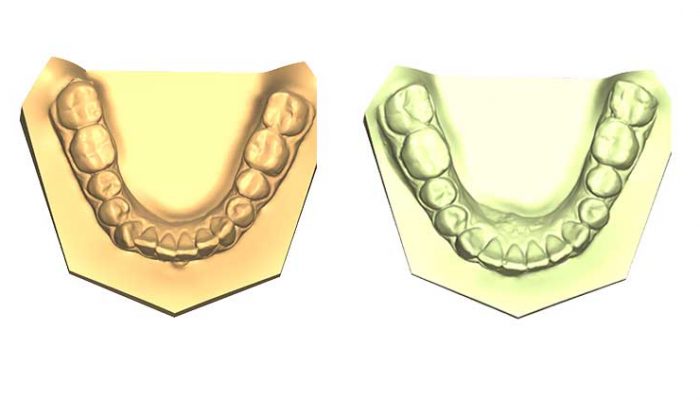 Open bite Seven Sessions