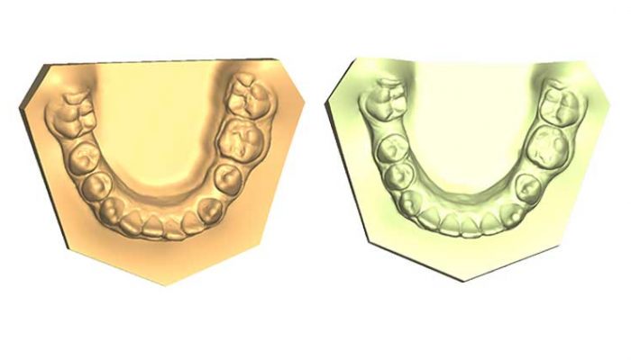 Overbite and Correct alignment Five Sessions