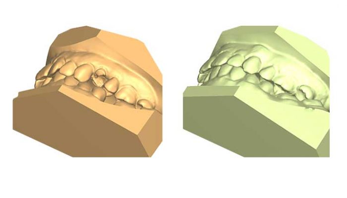 Mixed malocclusions and closed gap after tooth extraction. Six Sessions