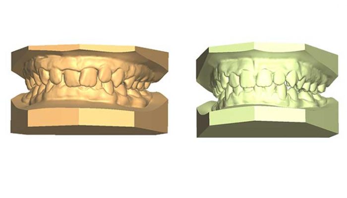 Overbite and Correct alignment Five Sessions