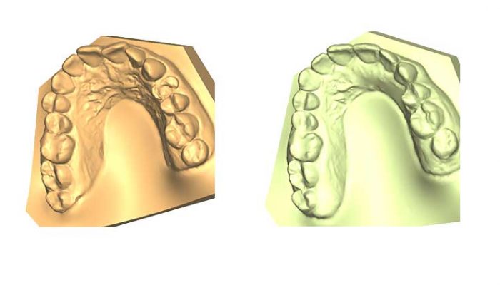 Mixed malocclusions and closed gap after tooth extraction. Six Sessions