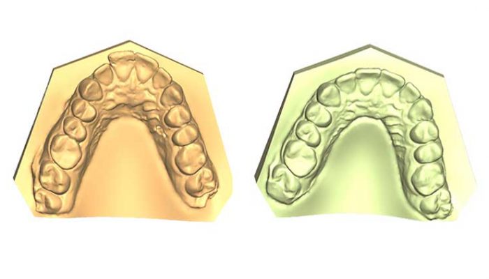 Open bite Seven Sessions