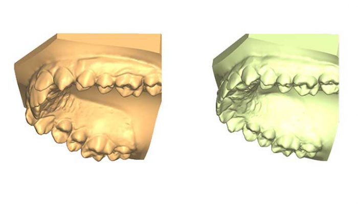 Overbite and Correct alignment Five Sessions