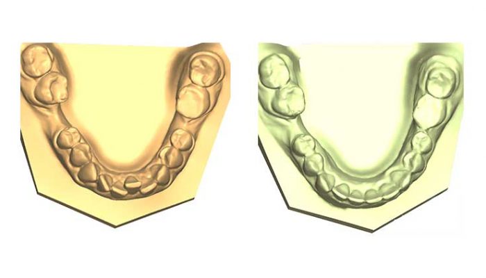 Mixed malocclusions and closed gap after tooth extraction. Six Sessions