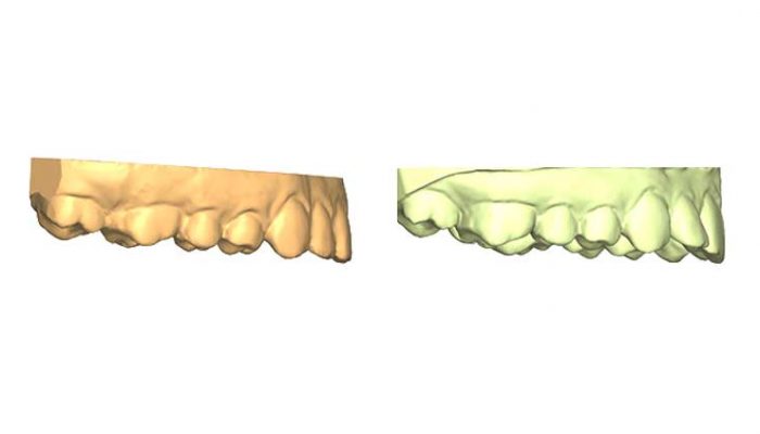 Little corrections after other braces Two Sessions
