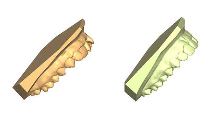 Overbite and Correct alignment Five Sessions