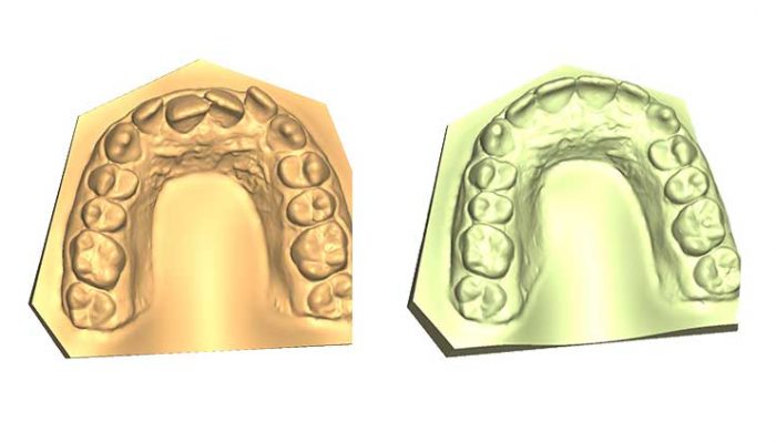 Overbite and Correct alignment Five Sessions
